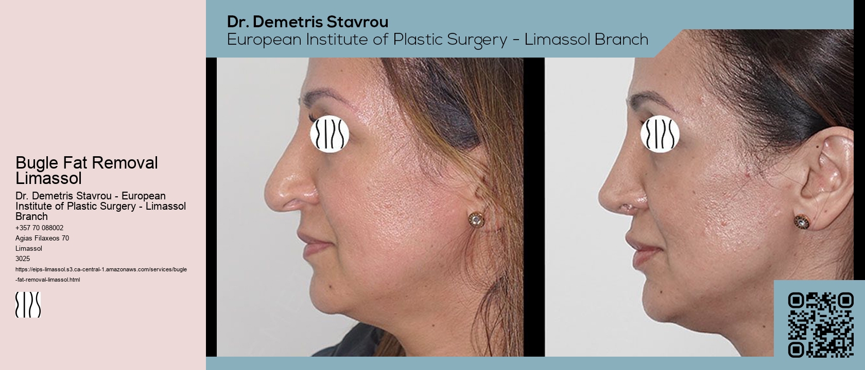 Bugle Fat Removal Limassol