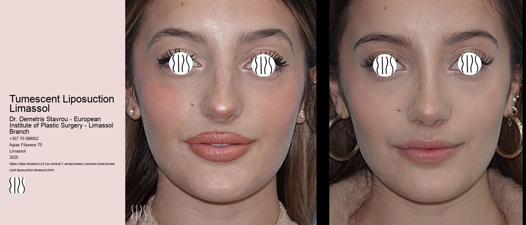 Tumescent Liposuction Limassol